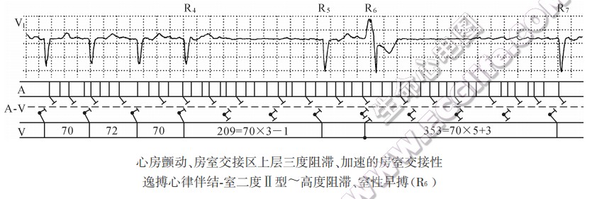 心房颤动、房室交接区上层三度阻滞、加速的房室交接性逸搏心律伴结.室二度Ⅱ型~高度阻滞、室性早搏(R6)(心电图)