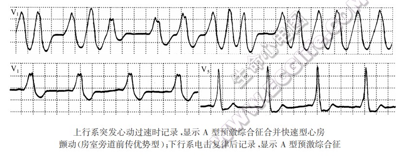 上行系突发心动过速时记录,显示A型预激综合征合并快速型心房颤动(房室旁道前传优势型);下行系电击复律后记录,显示A型预激综合征(心电图)