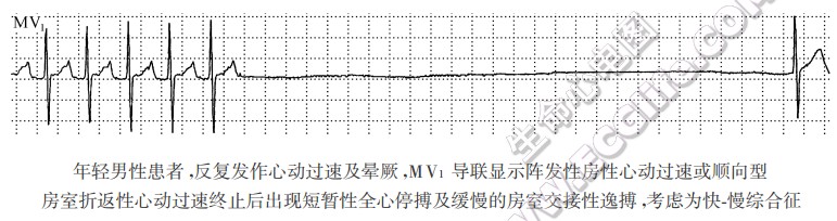 快-慢综合征(心电图)