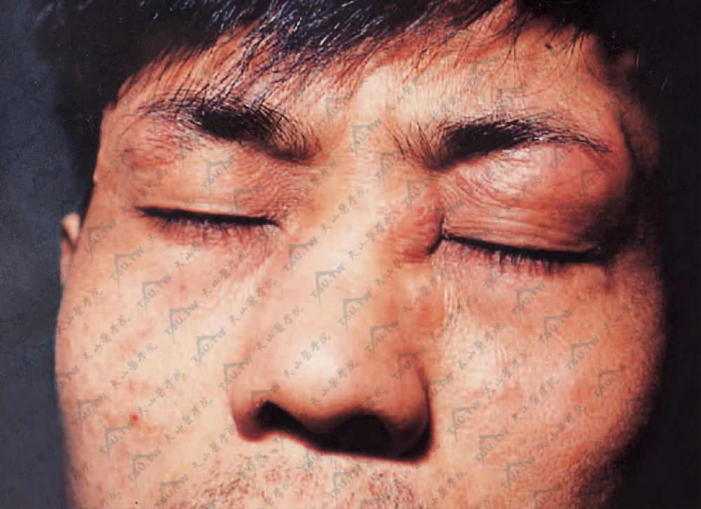 面部肉芽肿(granuloma faciale)