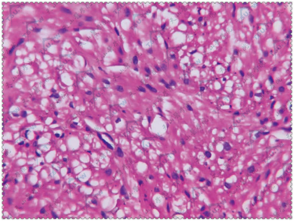 平滑肌瘤(Leiomyoma)肿瘤团块由不同走向的平滑肌构成(HE染色×400)