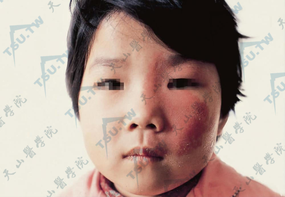 Sturge-Weber Syndrome(斯特奇-韦伯综合征、脑面血管瘤病综合征)患者症状:沿三叉神经分布区有单侧面部鲜红斑痣,患侧有突眼