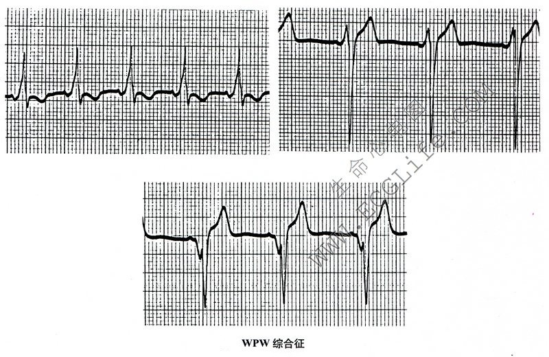 WPW综合征心电图