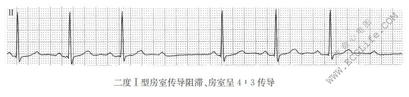 二度Ⅰ型房室传导阻滞、房室呈4:3传导（心电图）