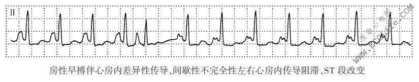 房性早搏伴心房内差异性传导、间歇性不完全性左右心房内传导阻滞、ST段改变（心电图）