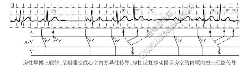 房性早搏三联律、呈阻滞型或心室内差异性传导、房性反复搏动揭示房窒结内顺向型三径路传导(心电图)
