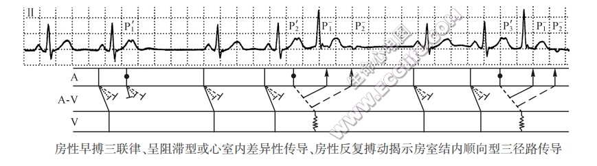 房性早搏三联律、呈阻滞型或心室内差异性传导、房性反复搏动揭示房窒结内顺向型三径路传导（心电图）