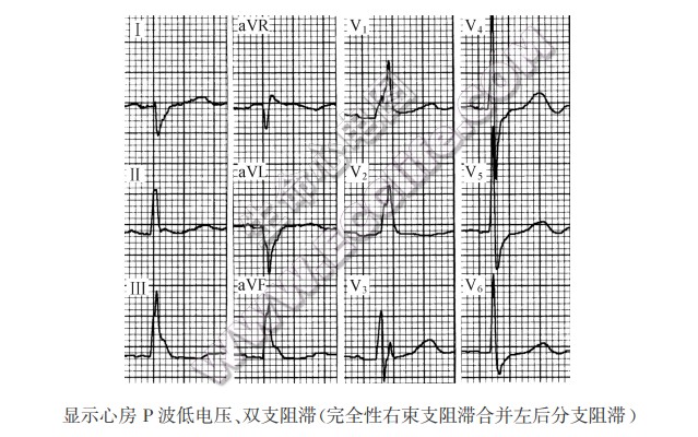 显示心房P波低电压、双支阻滞（完全性右柬支阻滞合并左后分支阻滞）