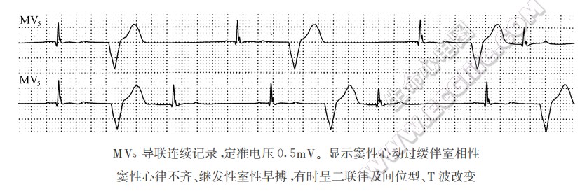 继发性室性早搏(心电图)
