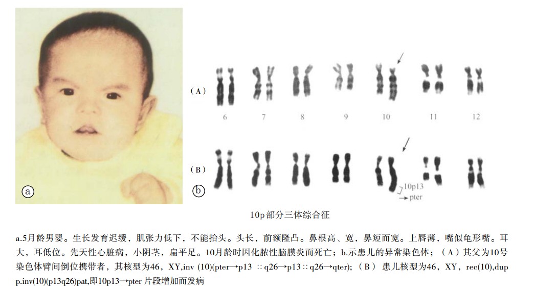 10p部分三体综合征患者表现