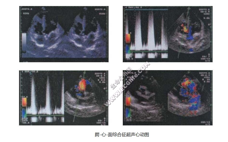 腭-心-面综合征超声心动图表现