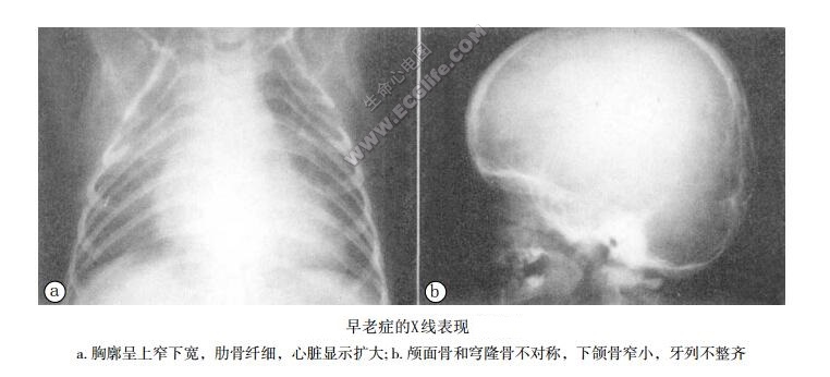 早老症患者头、胸X线表现