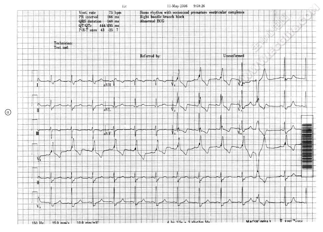 右束支阻滞诊断心电图