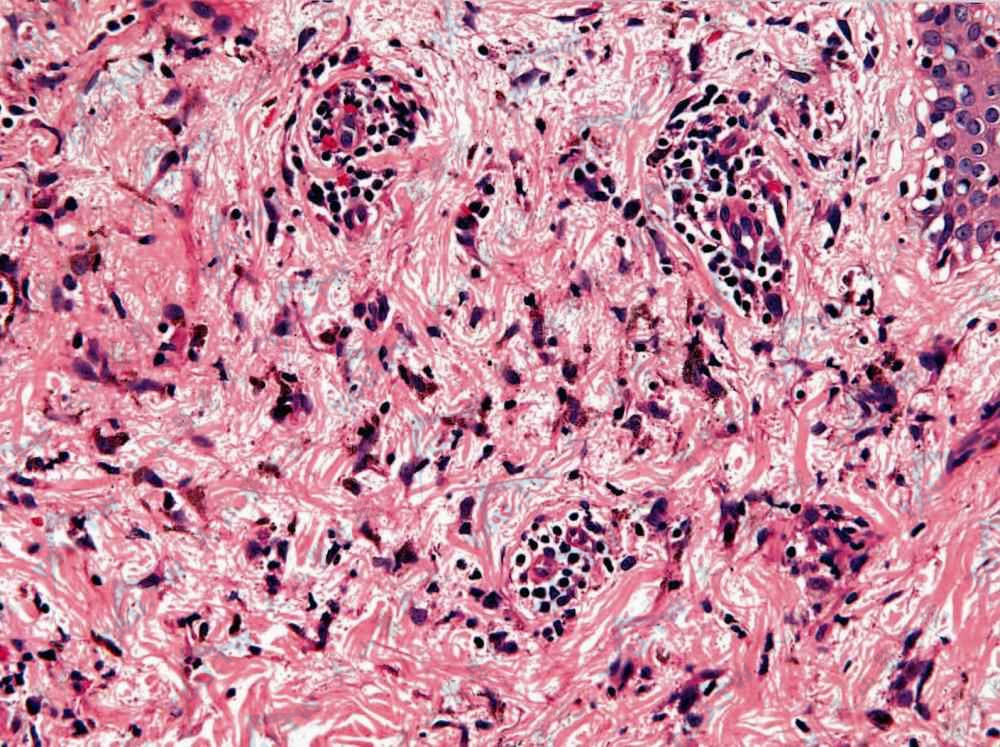 颈部假性皮萎缩