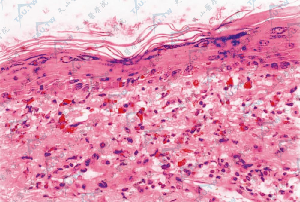 组织病理示基底层液化变性,真皮血管周围炎细胞浸润,噬黑素细胞内外有