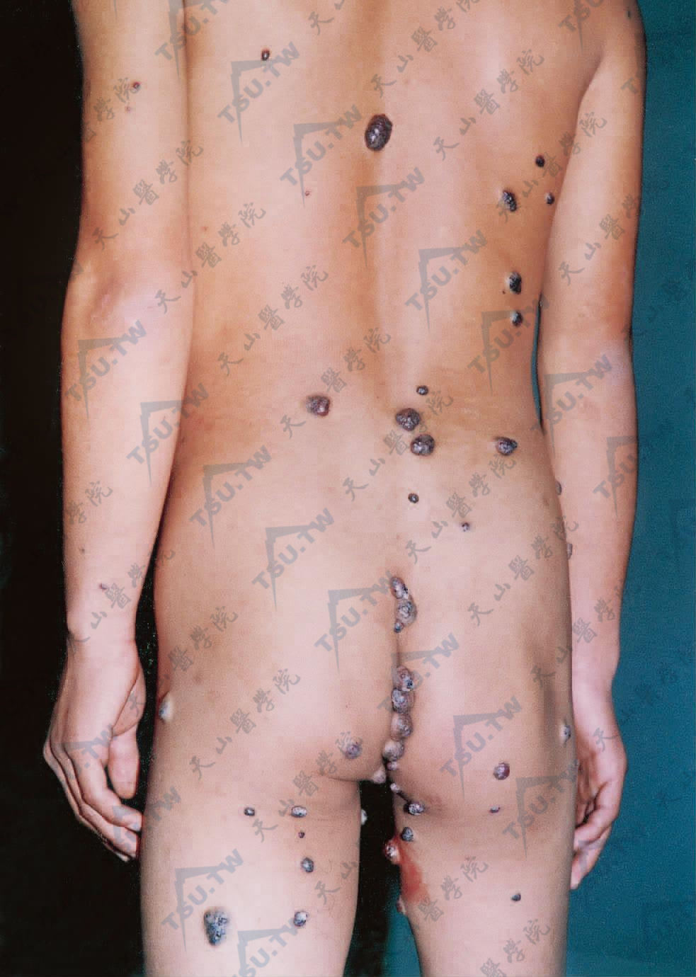 蓝色橡皮疱样痣综合征(Blue Rubber Bleb Nevus Syndrome)症状