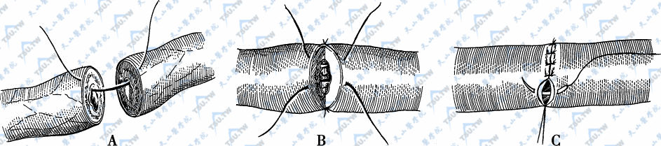 输精管一层缝合术